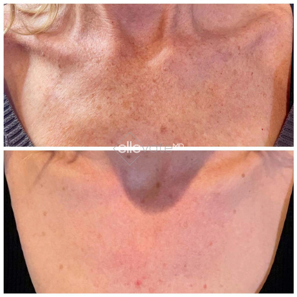 Before and After Gallery: Blepharoplasty Banner