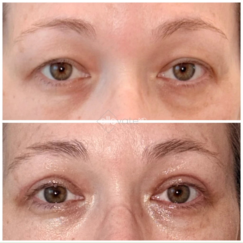 Before and after Signature Lid Lift displaying elevated eyelids with refreshed, brighter appearance