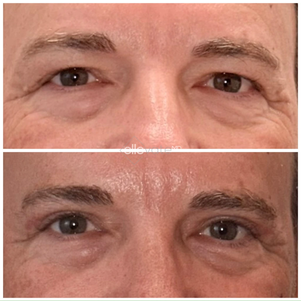Before and after eyelid lift showing reduced under-eye sagging and improved eyelid contour