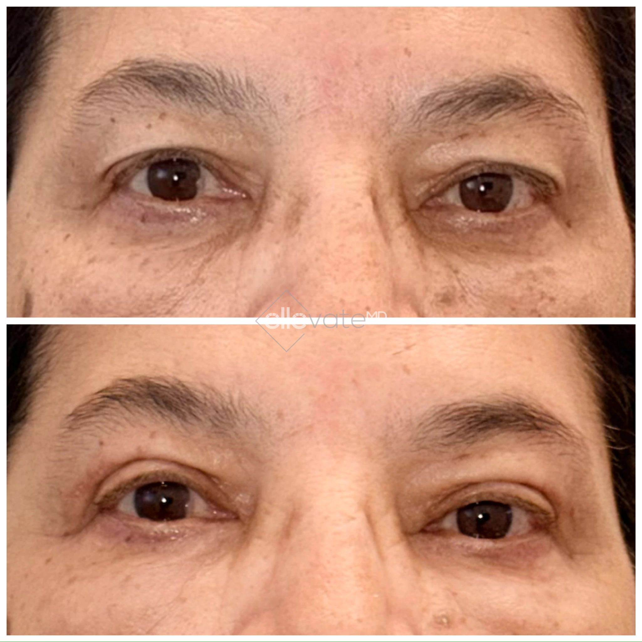 Before and after eyelid lift showing lifted eyelids and diminished lower lid bags