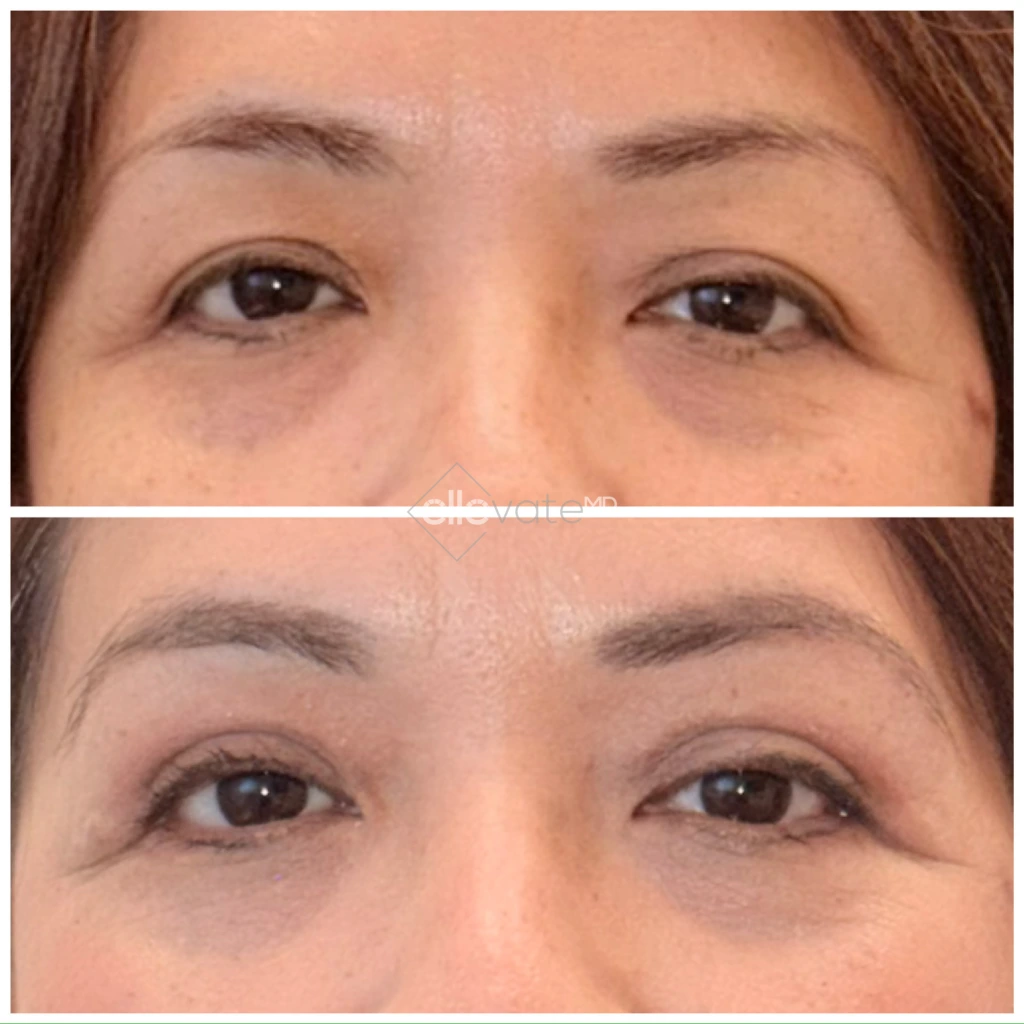 Before and after eyelid lift showing elevated upper lids and smoother under-eye area