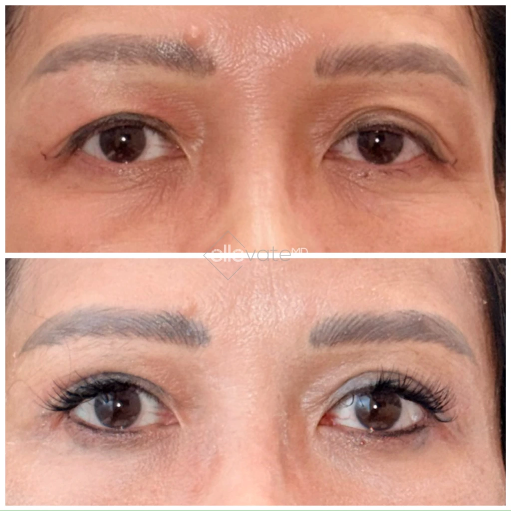 Before and after eyelid lift showing tightened lids and enhanced eye opening