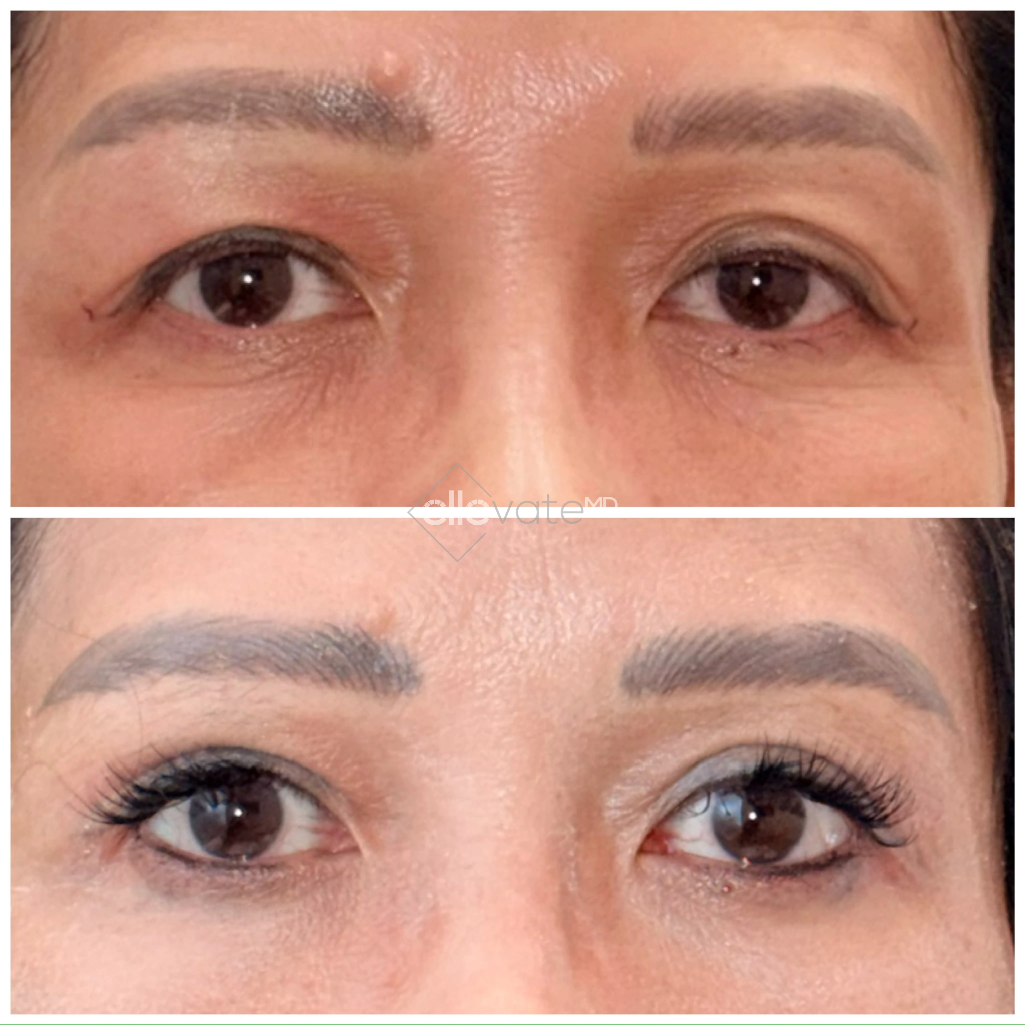 Before and after eyelid lift showing tightened lids and enhanced eye opening
