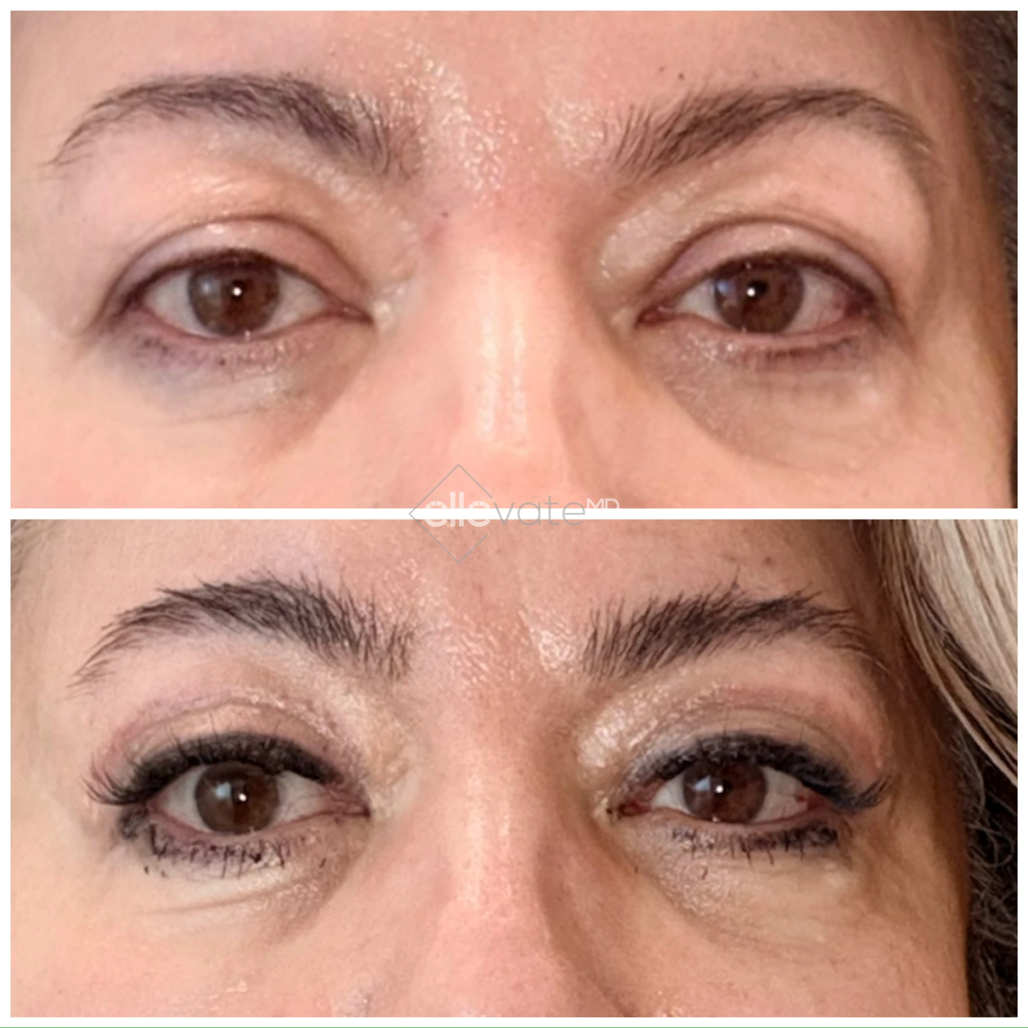 Before and after eyelid lift showing lifted eyelids and reduced puffiness with enhanced eye definition