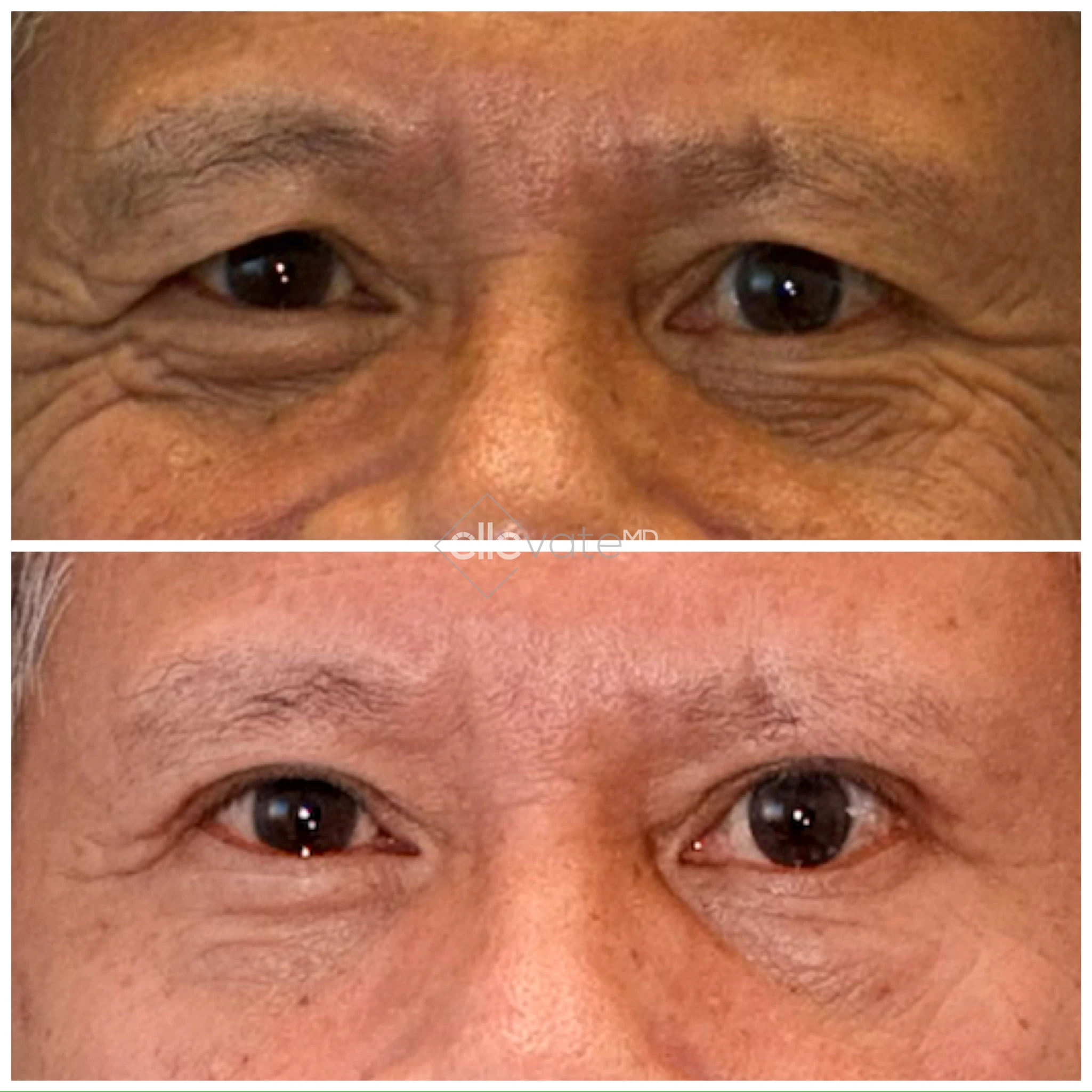 signature lid lift case 162