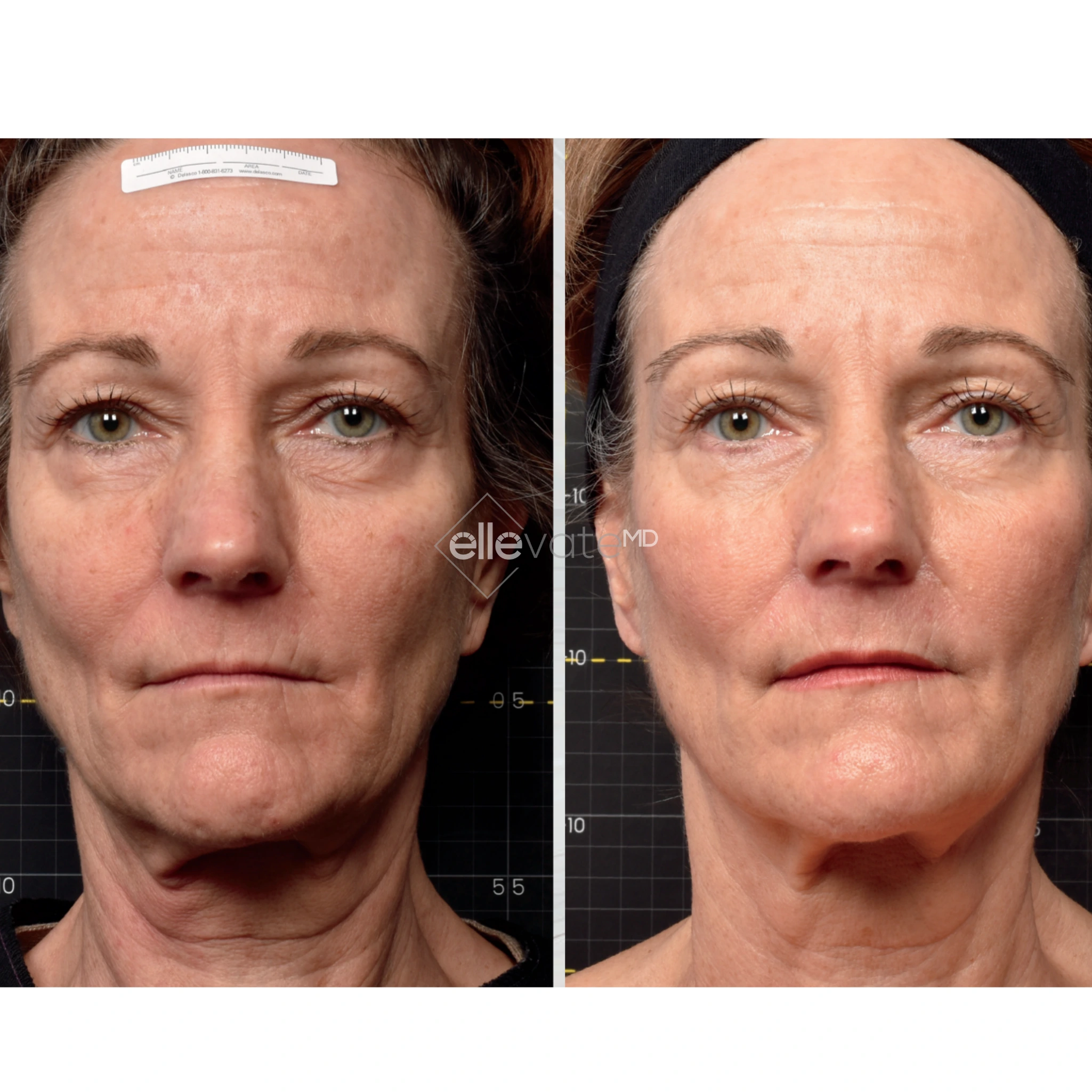 Before & After - Sofwave A Banner