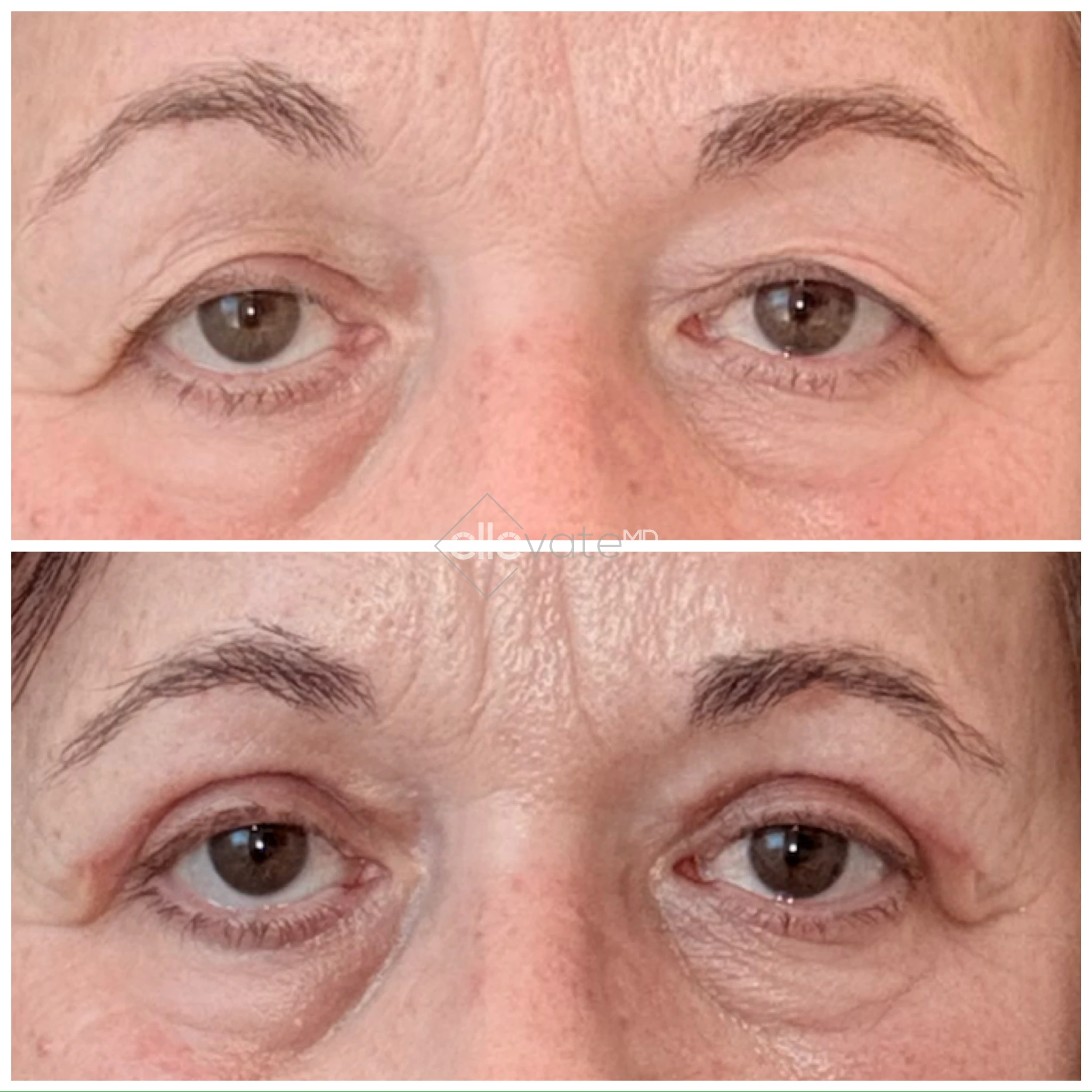 Before and after Signature Lid Lift revealing tightened eyelids and improved eye opening