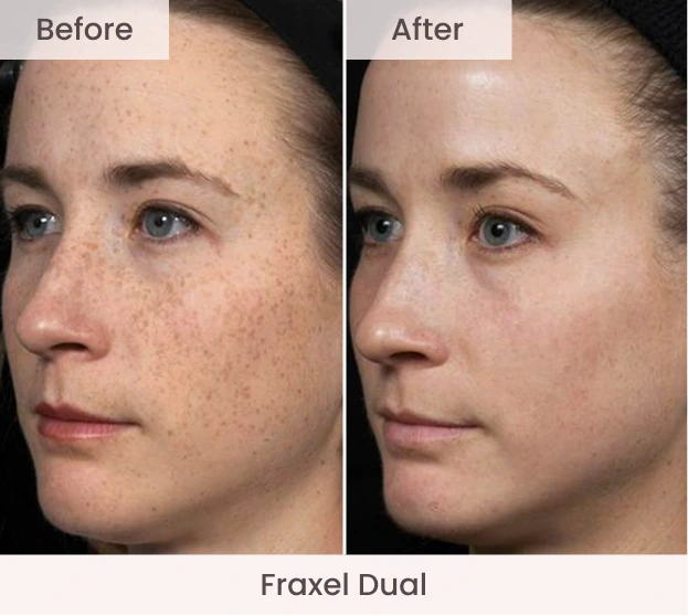 Before and after Fraxel Dual treatment showing reduced facial freckles and improved skin clarity