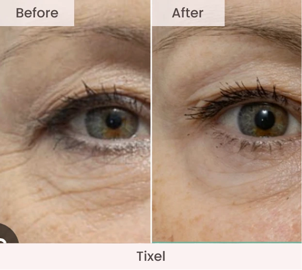 Close-up of eye area before and after Tixel showing reduced fine lines and wrinkles