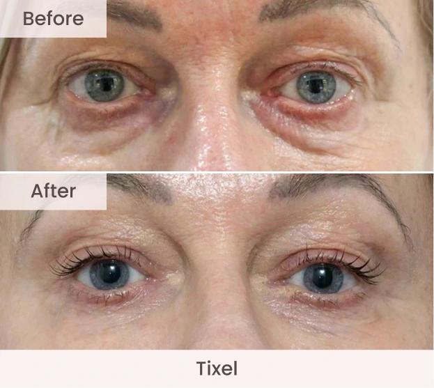 Front view of eyes before and after Tixel showing reduced under-eye bags and wrinkles