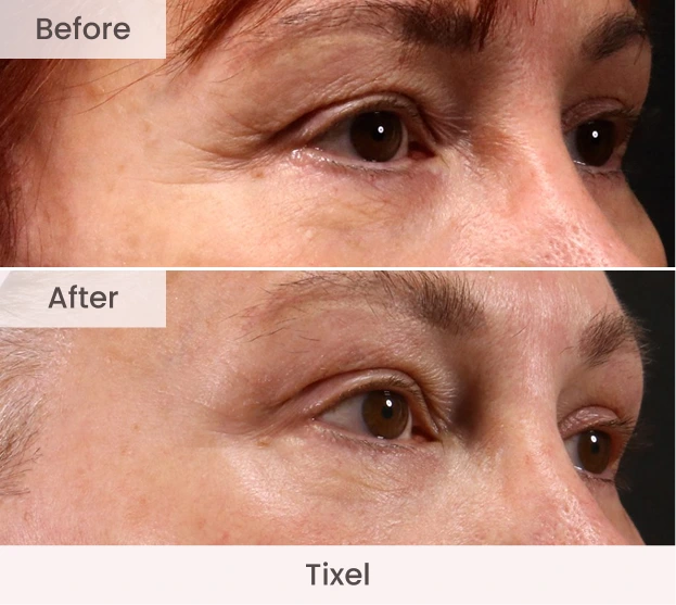 Side profile of eye area before and after Tixel showing improved fine lines and skin quality