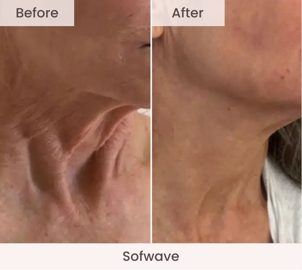 Before and after Sofwave treatment showing reduced jawline wrinkles and improved skin texture