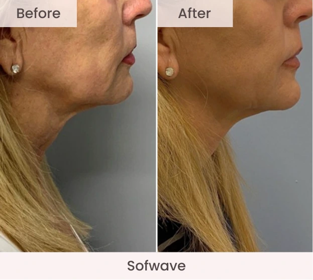Before and after Sofwave treatment showing improved neck and jawline definition in side profile