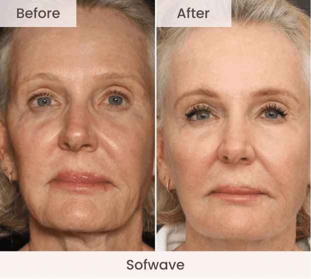 Before and after Sofwave treatment showing reduced forehead wrinkles and improved skin smoothness