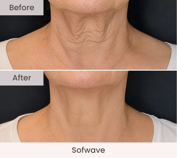 Before and after Sofwave treatment showing reduced neck wrinkles and improved skin tightness