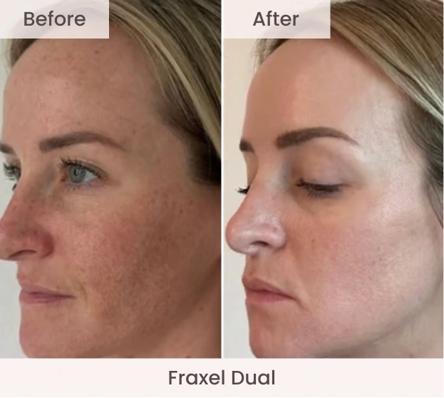 Side-by-side before and after facial profile showing improved skin texture and reduced discoloration with Fraxel Dual treatment