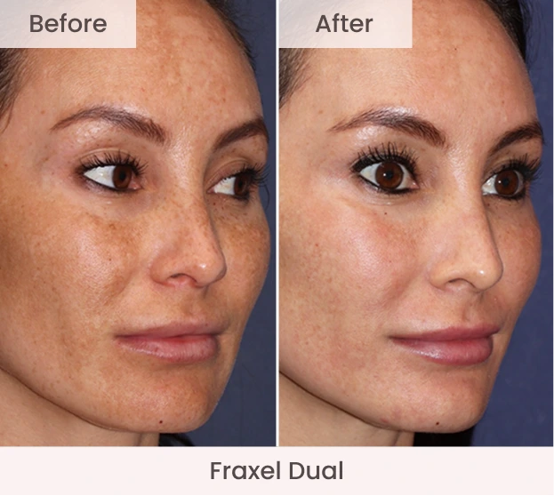 Side-by-side before and after angled facial view showing smoother skin texture and reduced sun damage with Fraxel Dual treatment