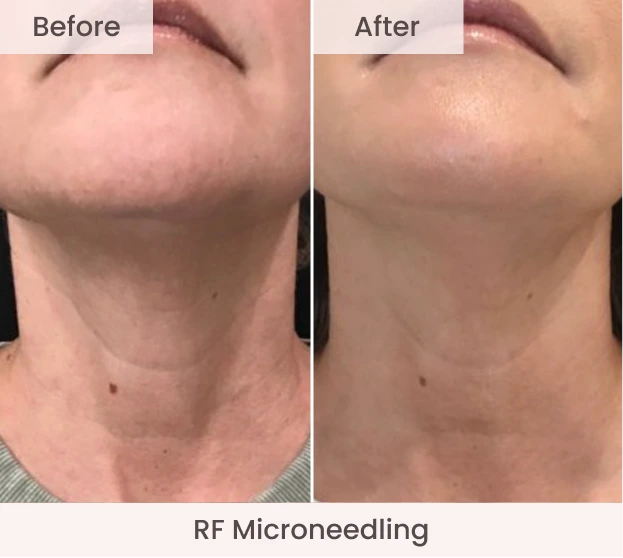Side-by-side before and after neck and jawline showing improved skin laxity and texture with RF Microneedling treatment