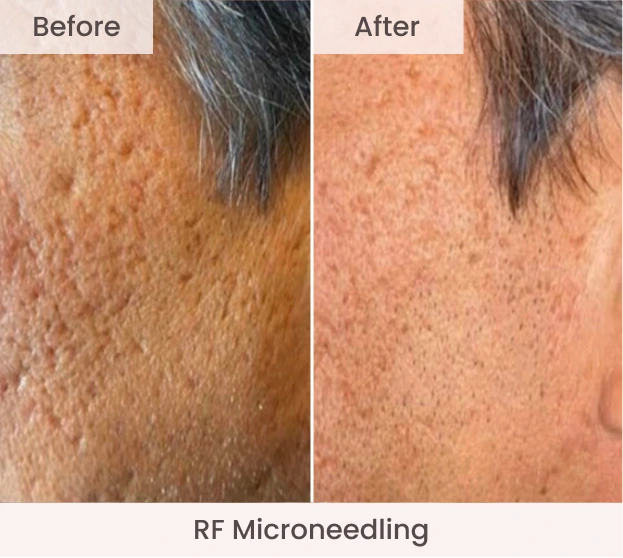 Side-by-side before and after close-up of neck showing reduced texture and pore size with RF Microneedling treatment