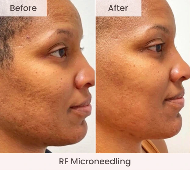 Side profile before and after RF Microneedling showing improved skin texture and reduced appearance of blemishes