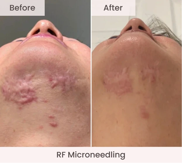 Back of neck before and after RF Microneedling showing reduced acne and improved skin clarity