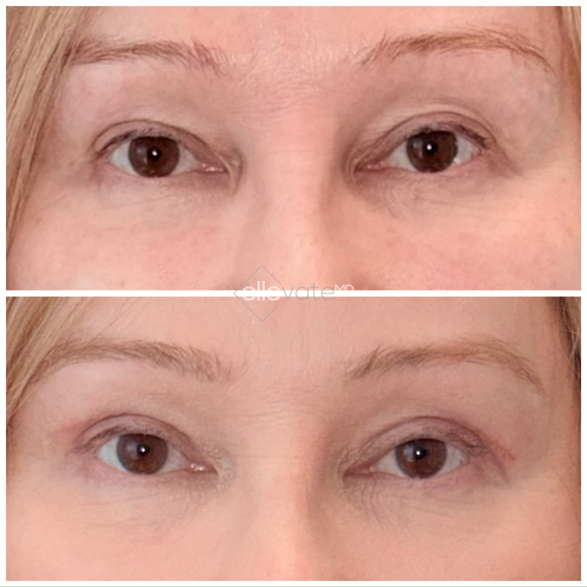 Patient frontal view before and after signature lift, displaying improved eyelid contour