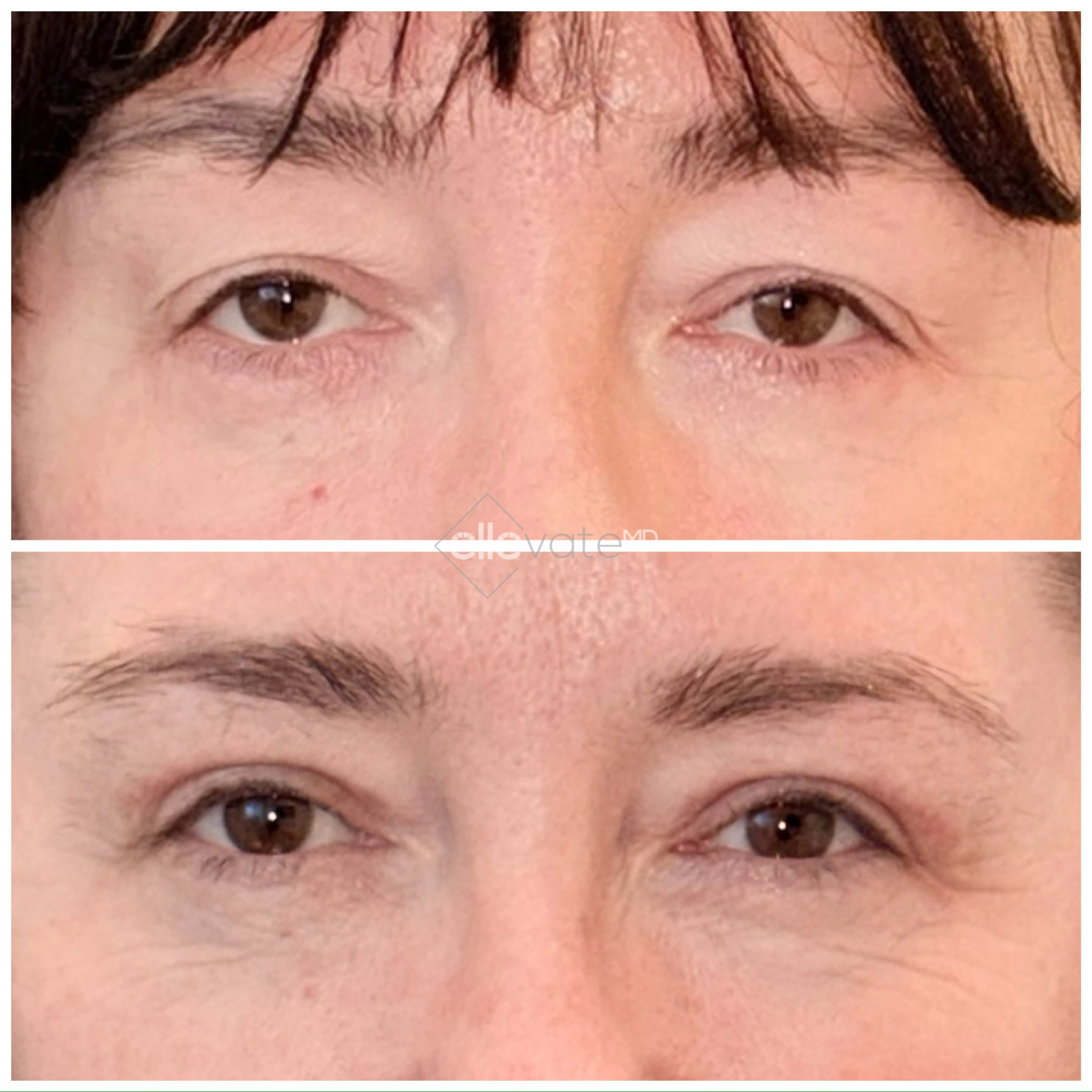 Patient frontal view before and after signature lift, showing lifted eyelids and reduced sagging