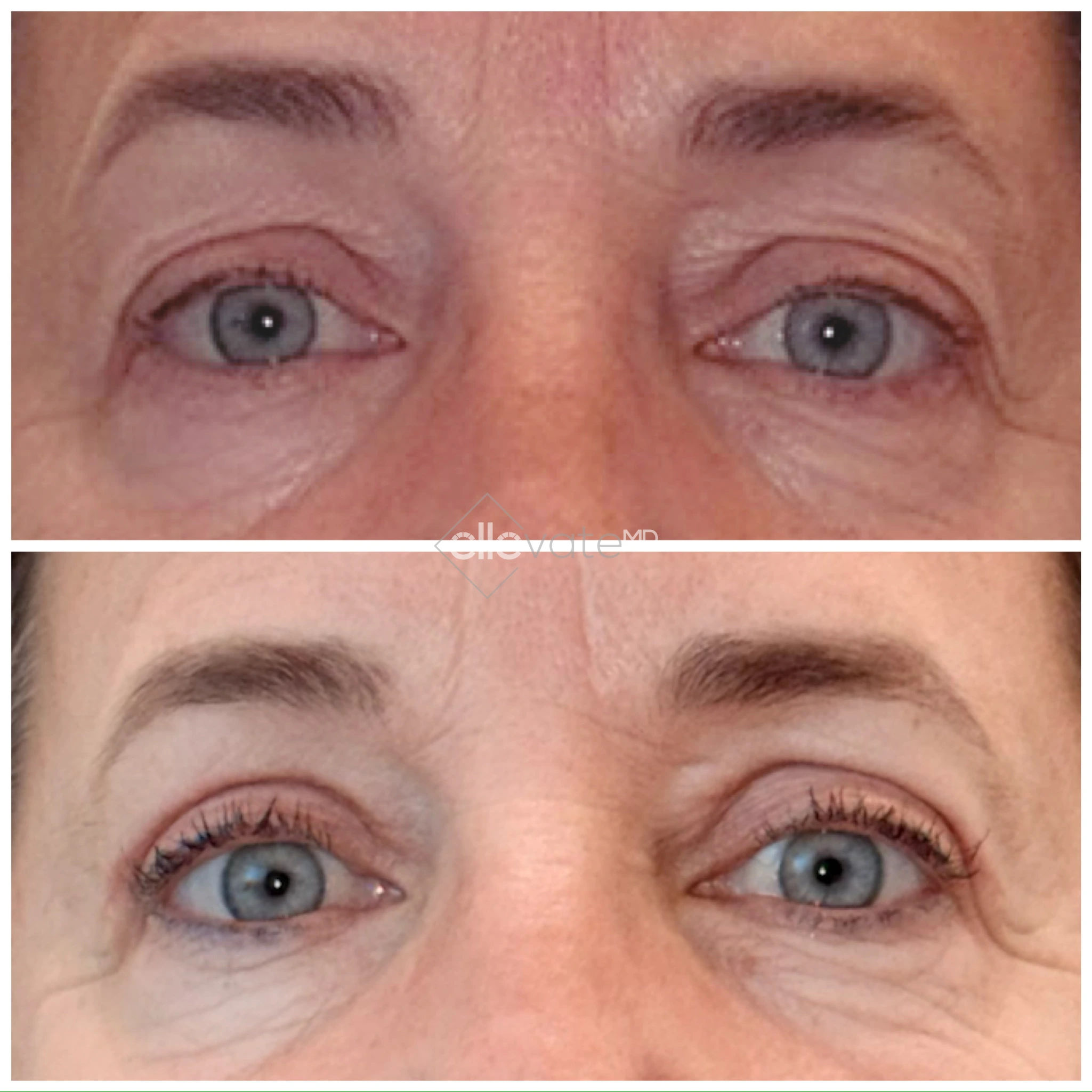 Patient frontal view before and after signature lift, demonstrating enhanced eyelid definition