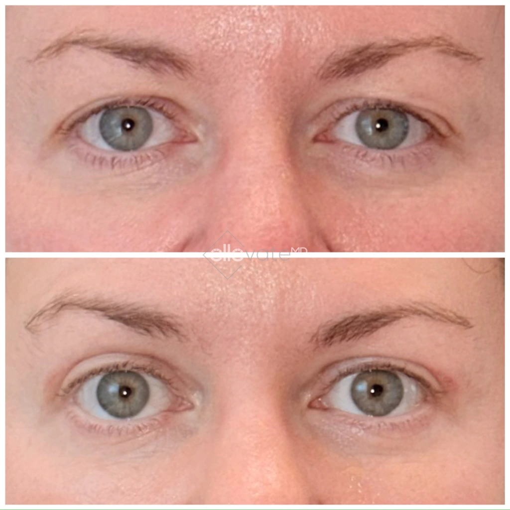 Before and after comparison of eyes showing reduced under-eye hollowing and improved eyelid lift