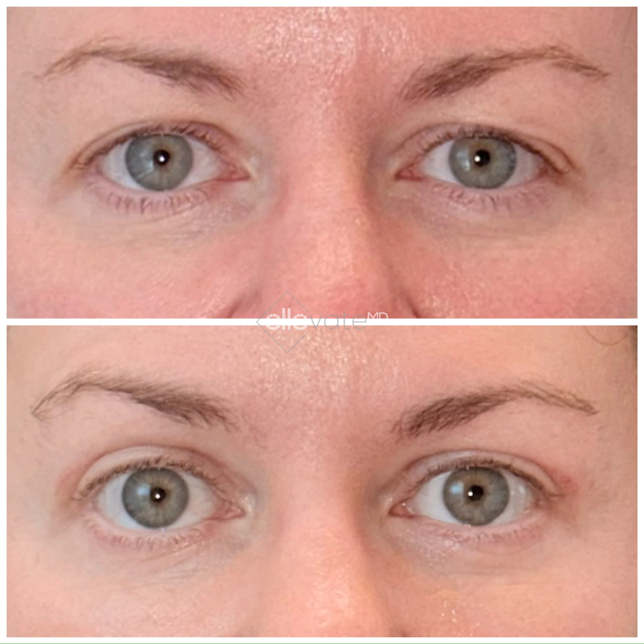 Before and after comparison of eyes showing reduced under-eye hollowing and improved eyelid lift