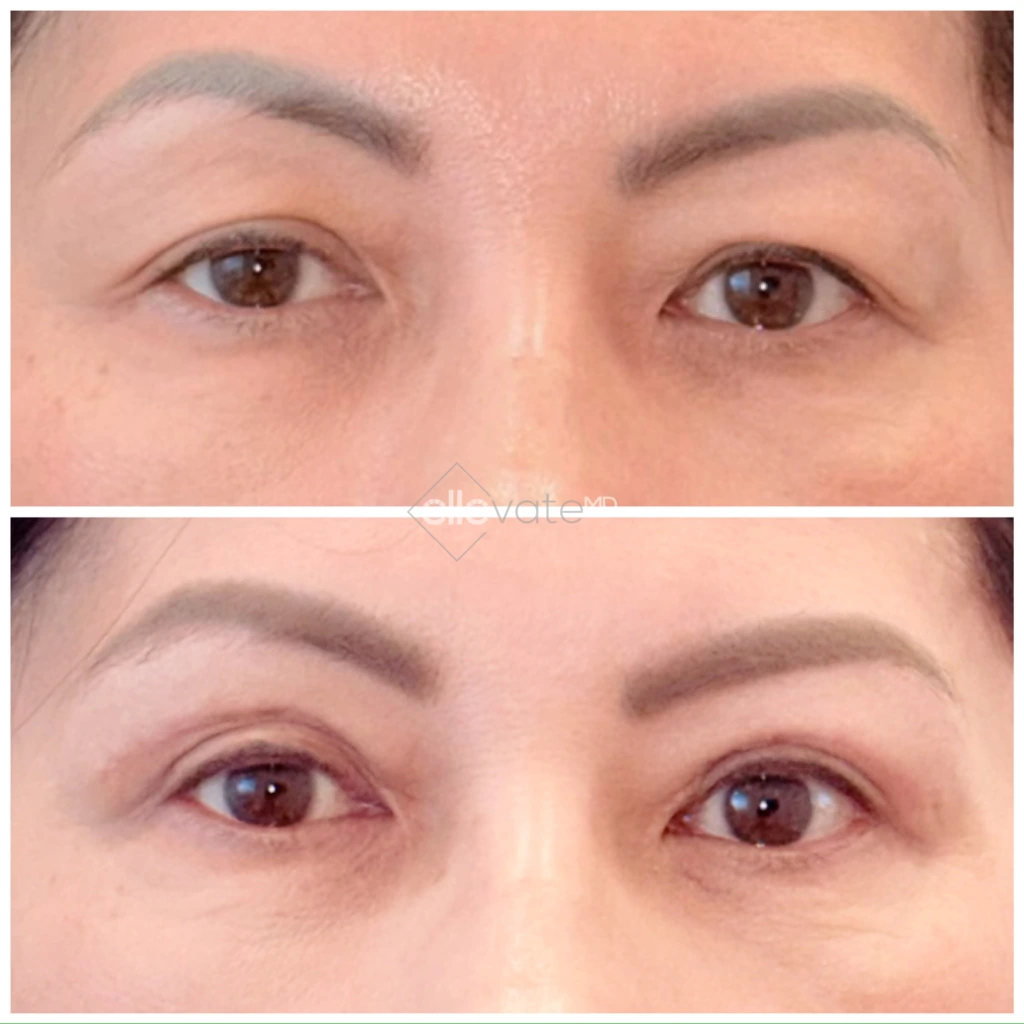 Before and after comparison of eyes showing improved eyelid elevation and reduced under-eye bags