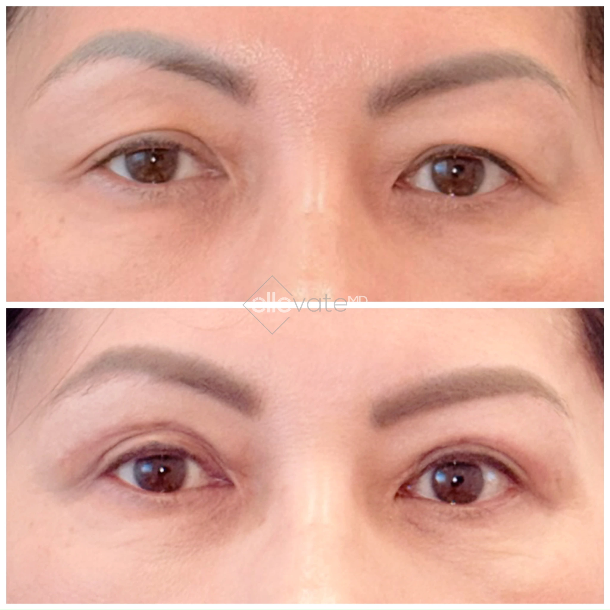 Before and after comparison of eyes showing improved eyelid elevation and reduced under-eye bags
