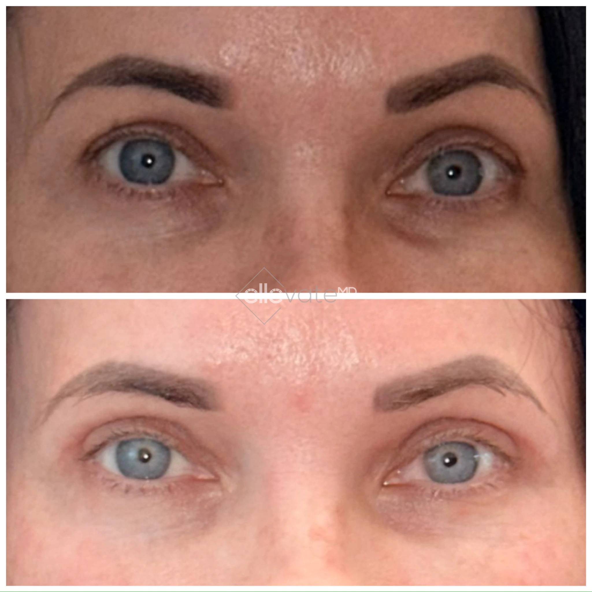 Before and after comparison of eyes showing lifted eyelids and improved eye opening