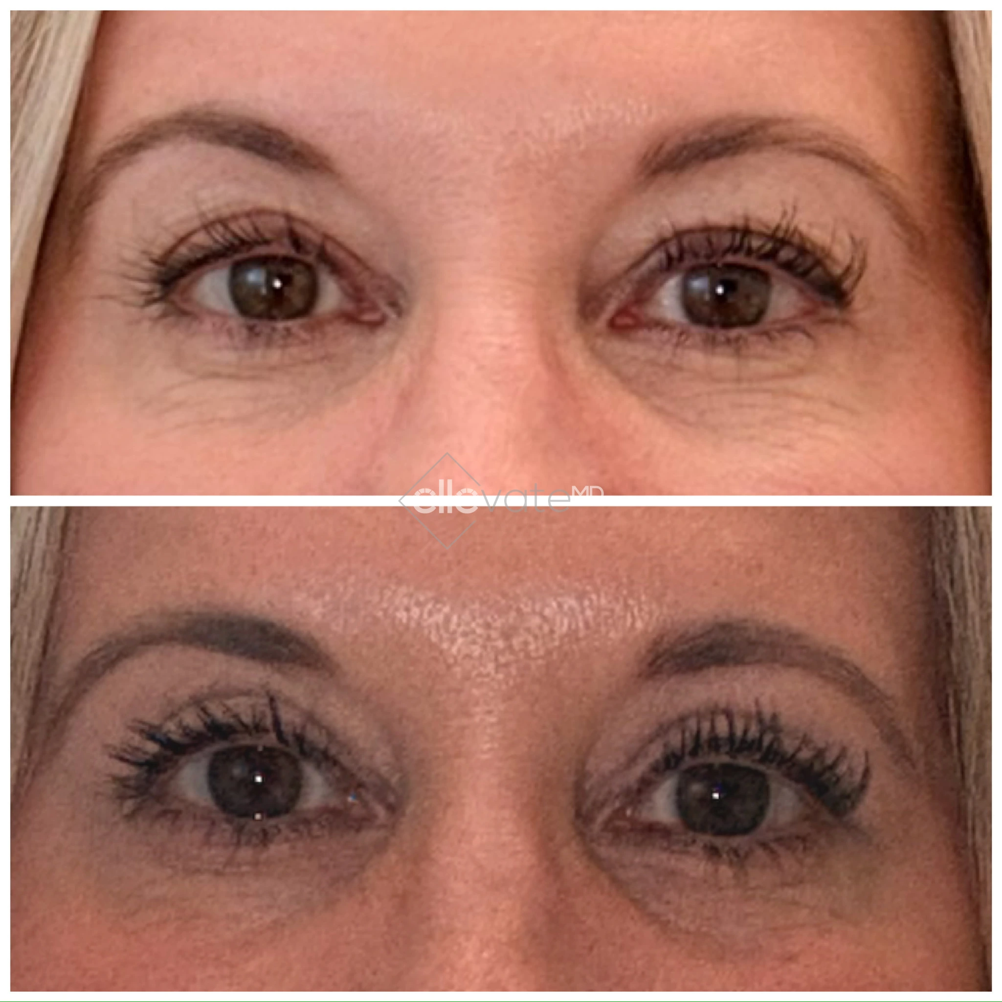 Before and after comparison of eyes showing reduced crow's feet and improved upper eyelid contour