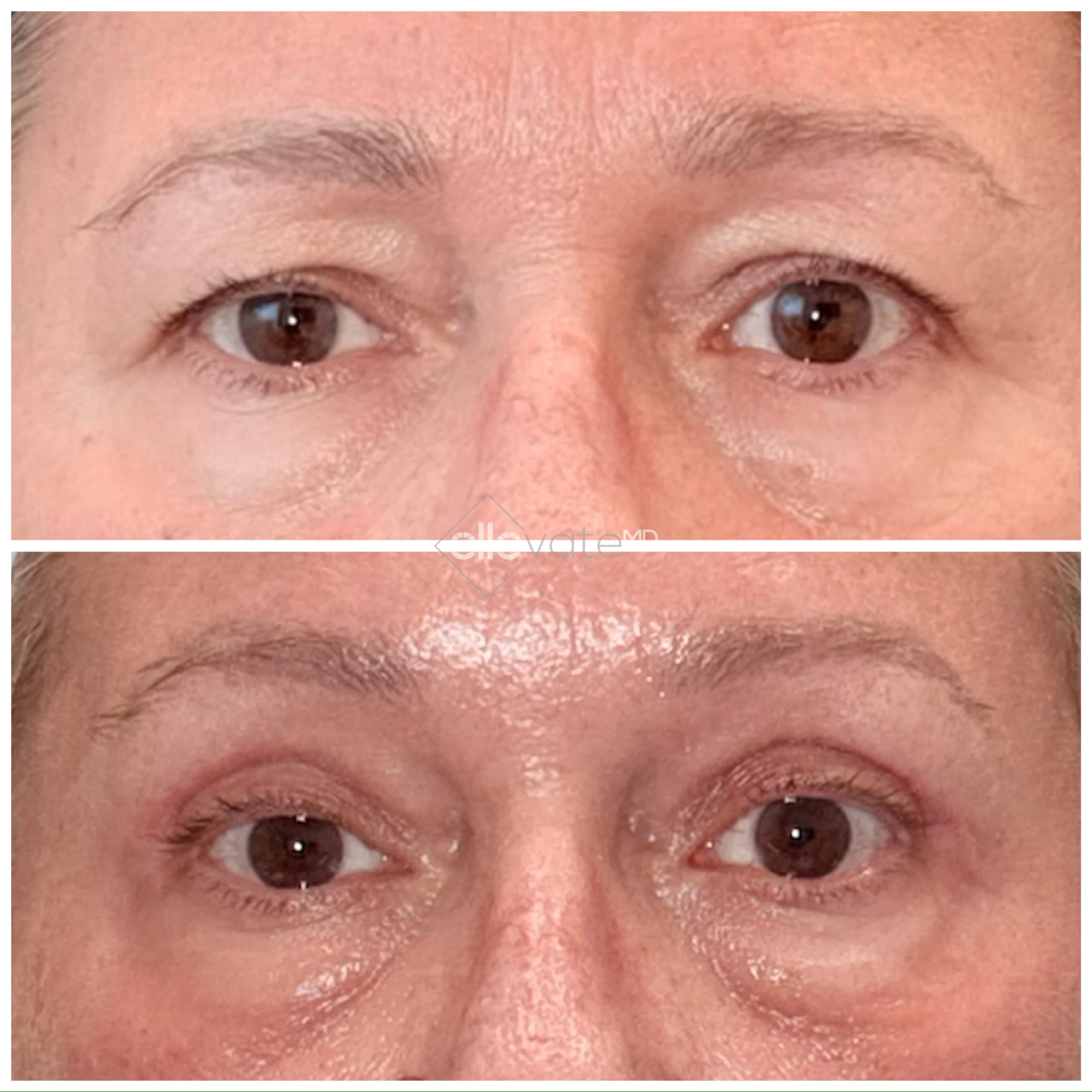 Before and after comparison of eyes showing lifted eyebrows and reduced under-eye puffiness