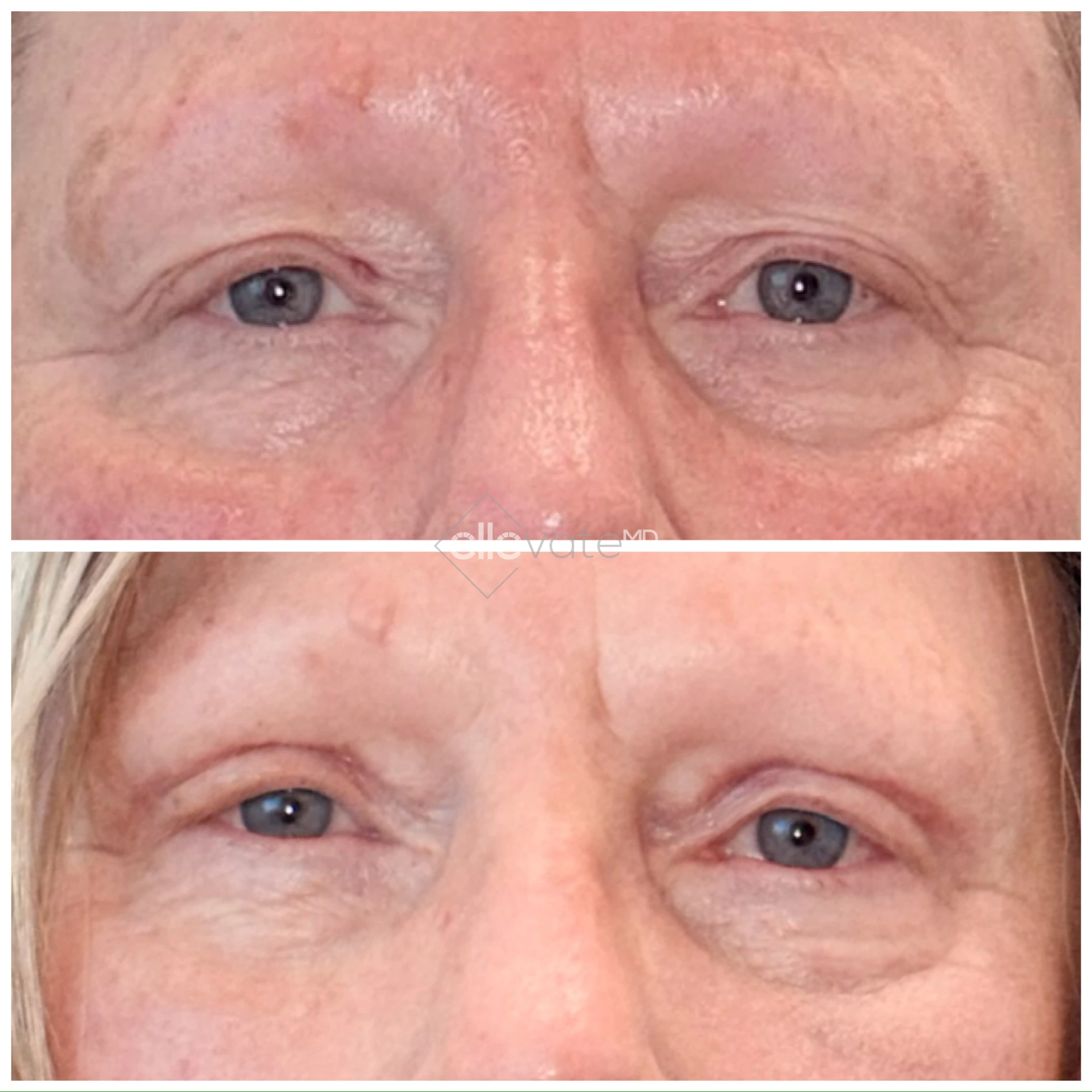 Before and after comparison of eyes showing improved eyelid support and smoother under-eye area