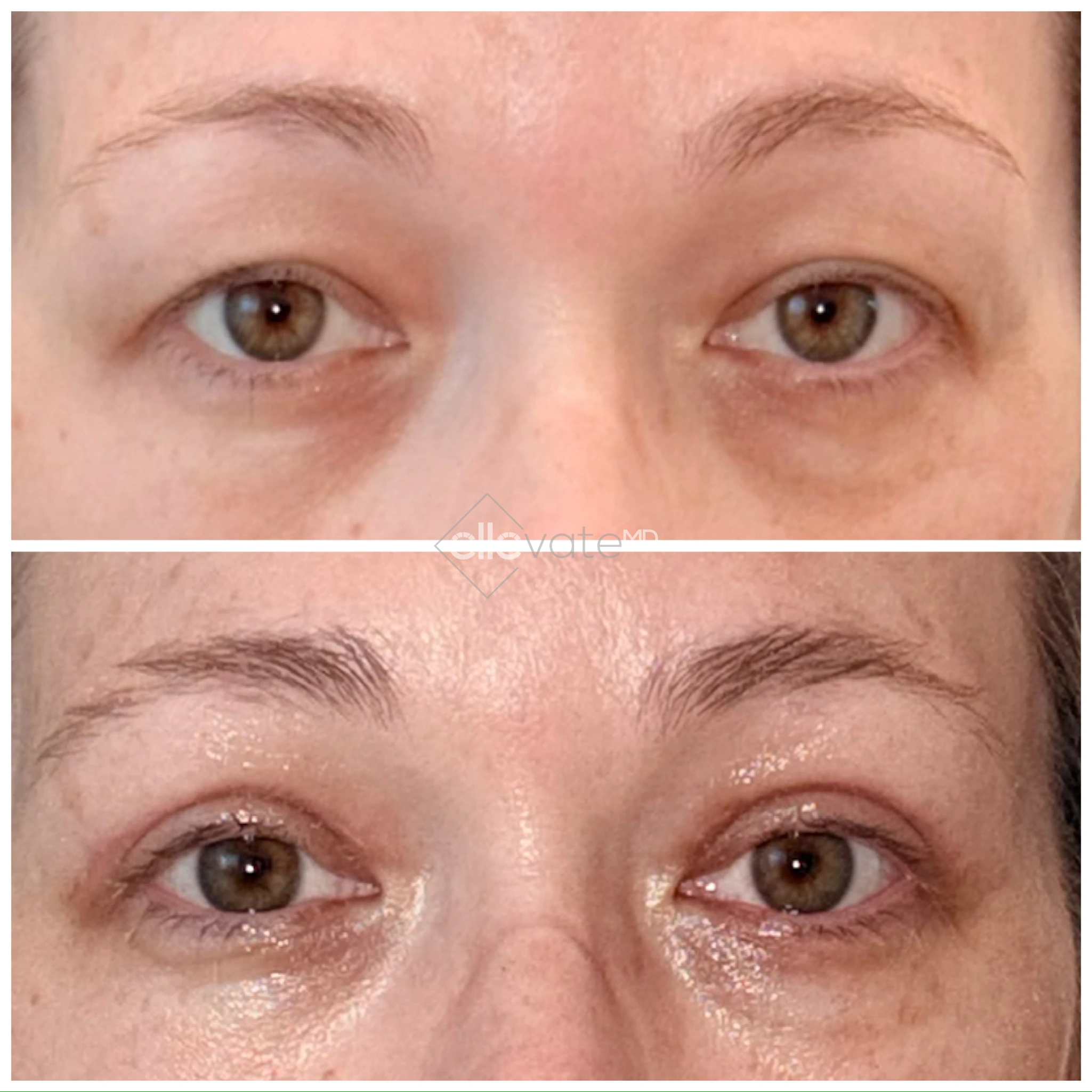Before and after Signature Lift treatment showing reduced under-eye hollowness and improved eye area definition