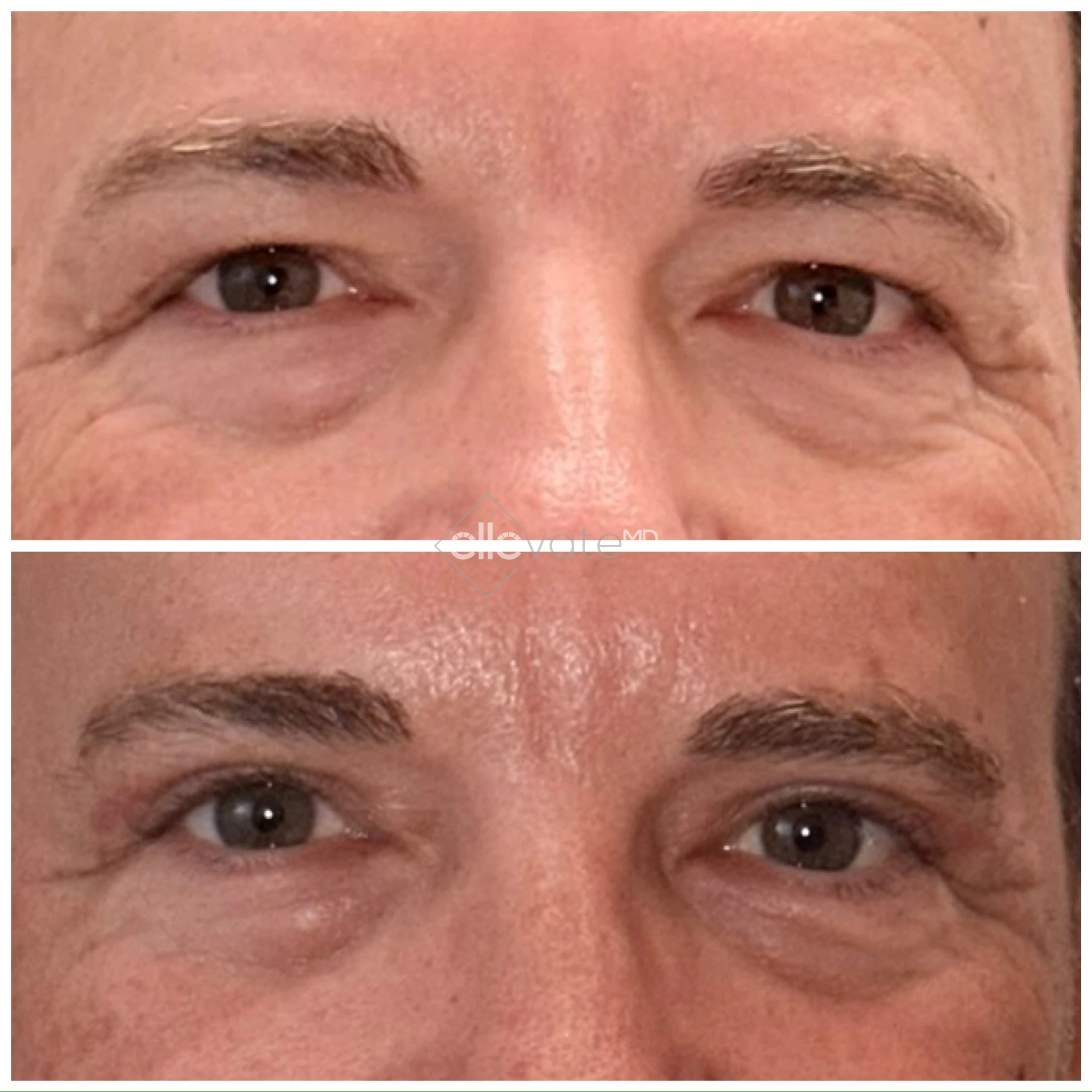 Before and after Signature Lift showing improved eye opening and reduced upper eyelid heaviness