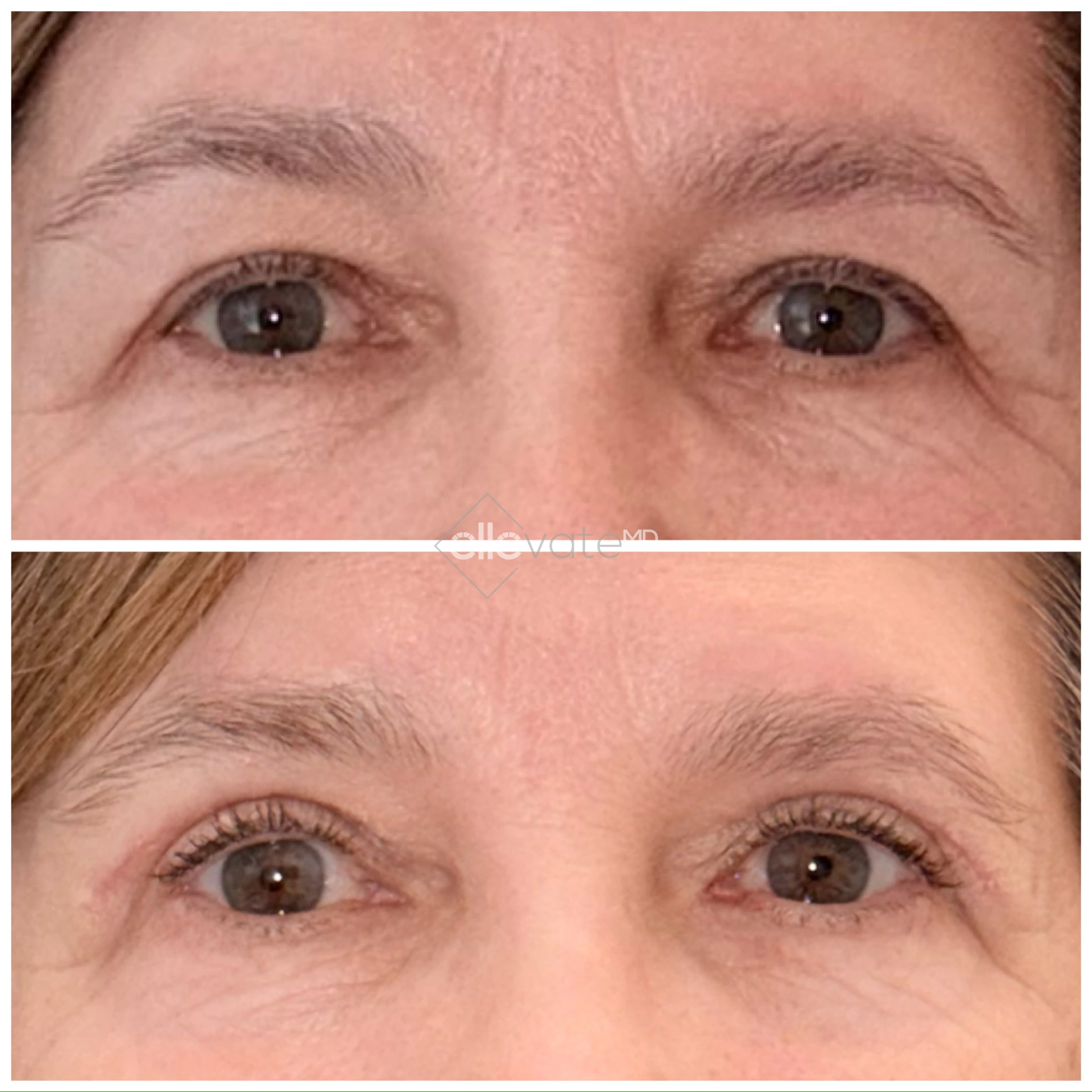 Before and after Signature Lift demonstrating reduced crow's feet and improved eye area volume