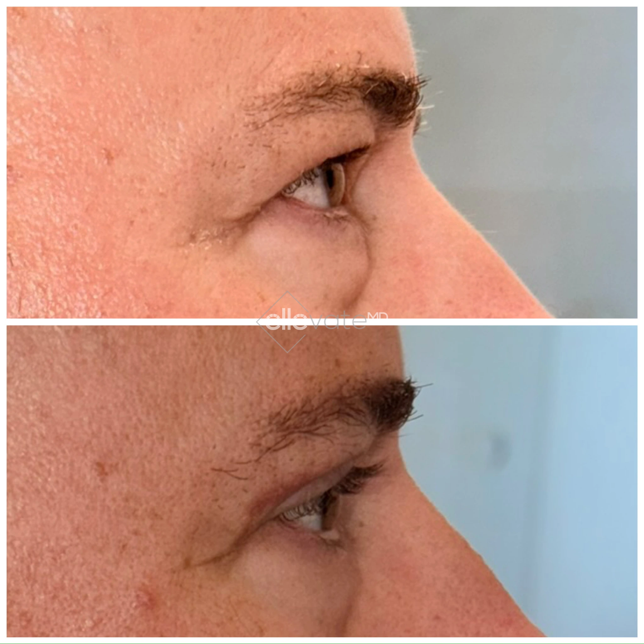 Before and after profile view of upper eyelid lift showing increased lid opening and elevated brow position