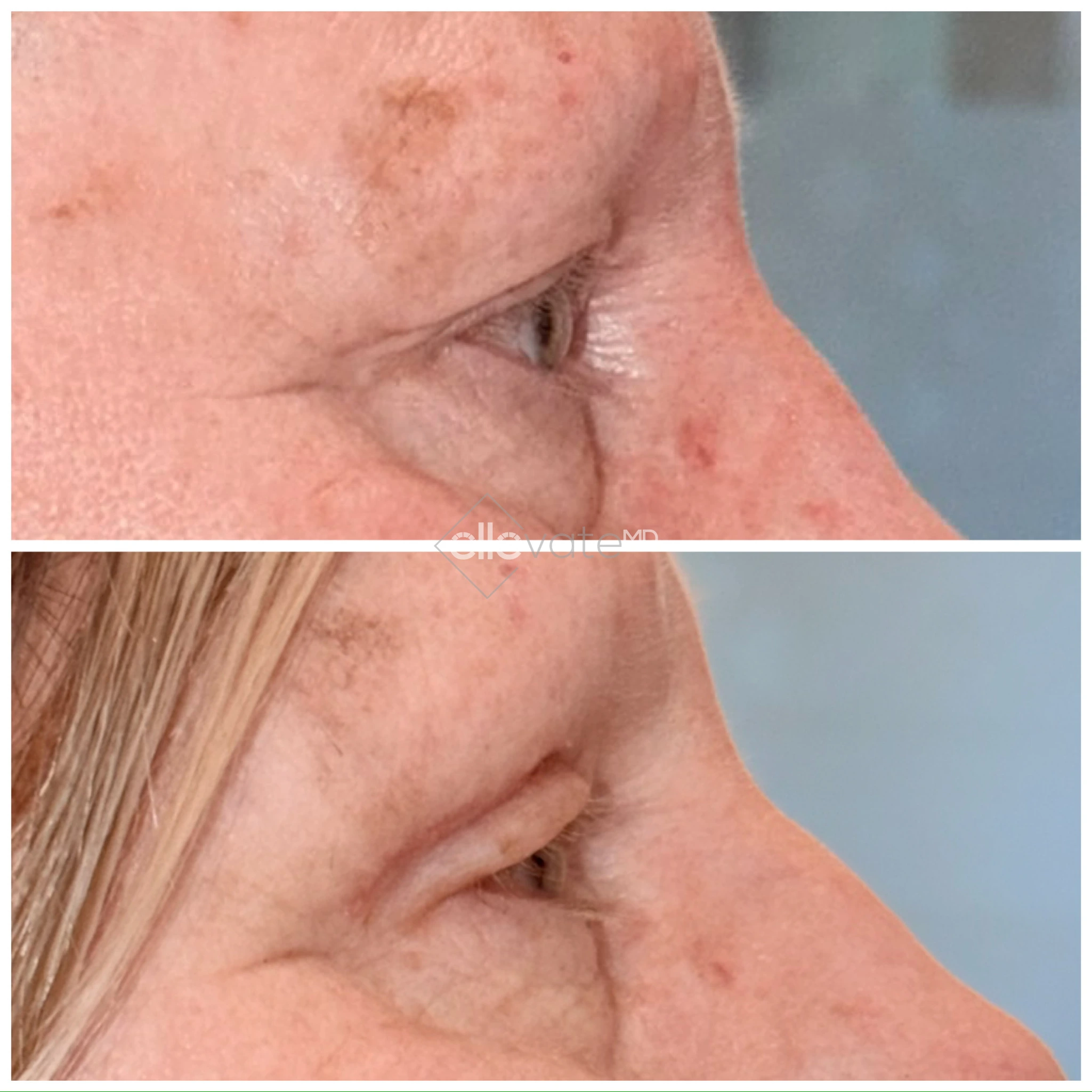 Before and after profile view of upper eyelid lift with improved lid contour and reduced drooping