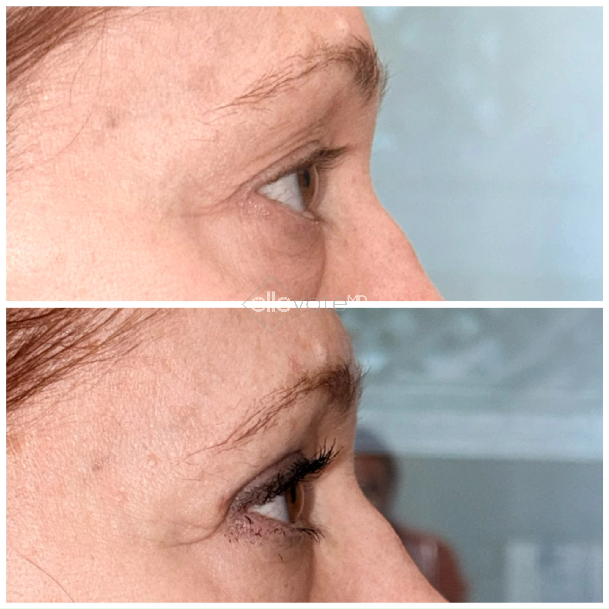 Before and after profile view of upper eyelid lift showing lifted eyelid position and improved appearance