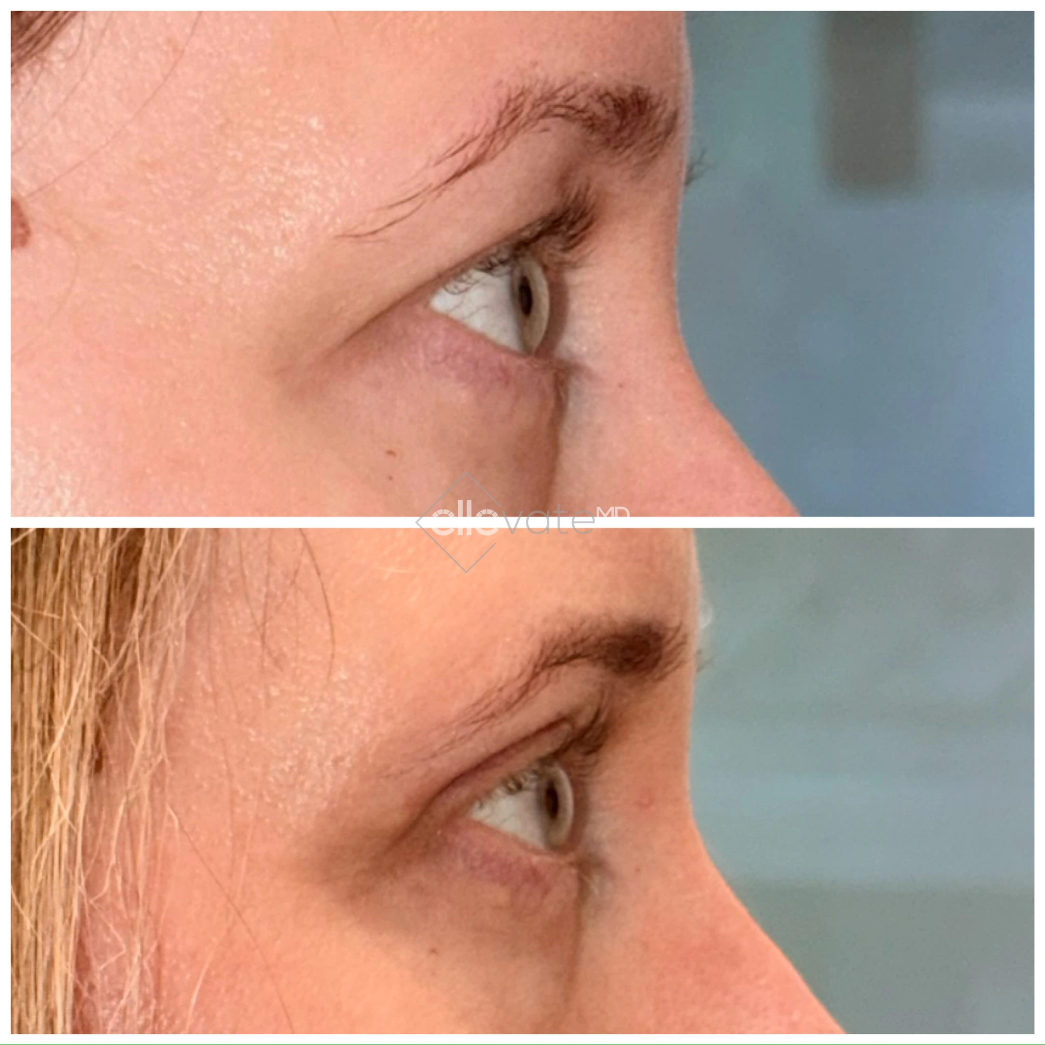 Before and after profile view of upper eyelid lift with increased upper lid exposure and refined eye contour