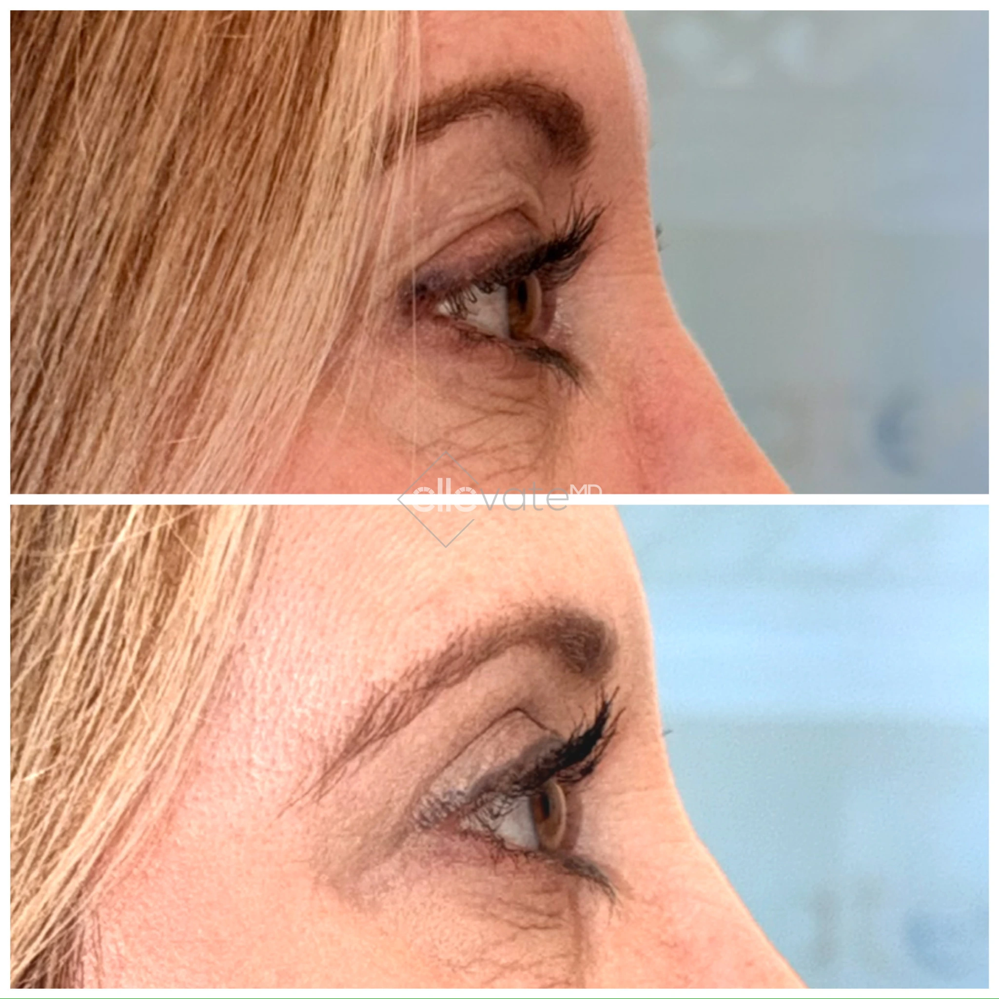 Before and after profile view of upper eyelid lift with lifted brow and eyelid position