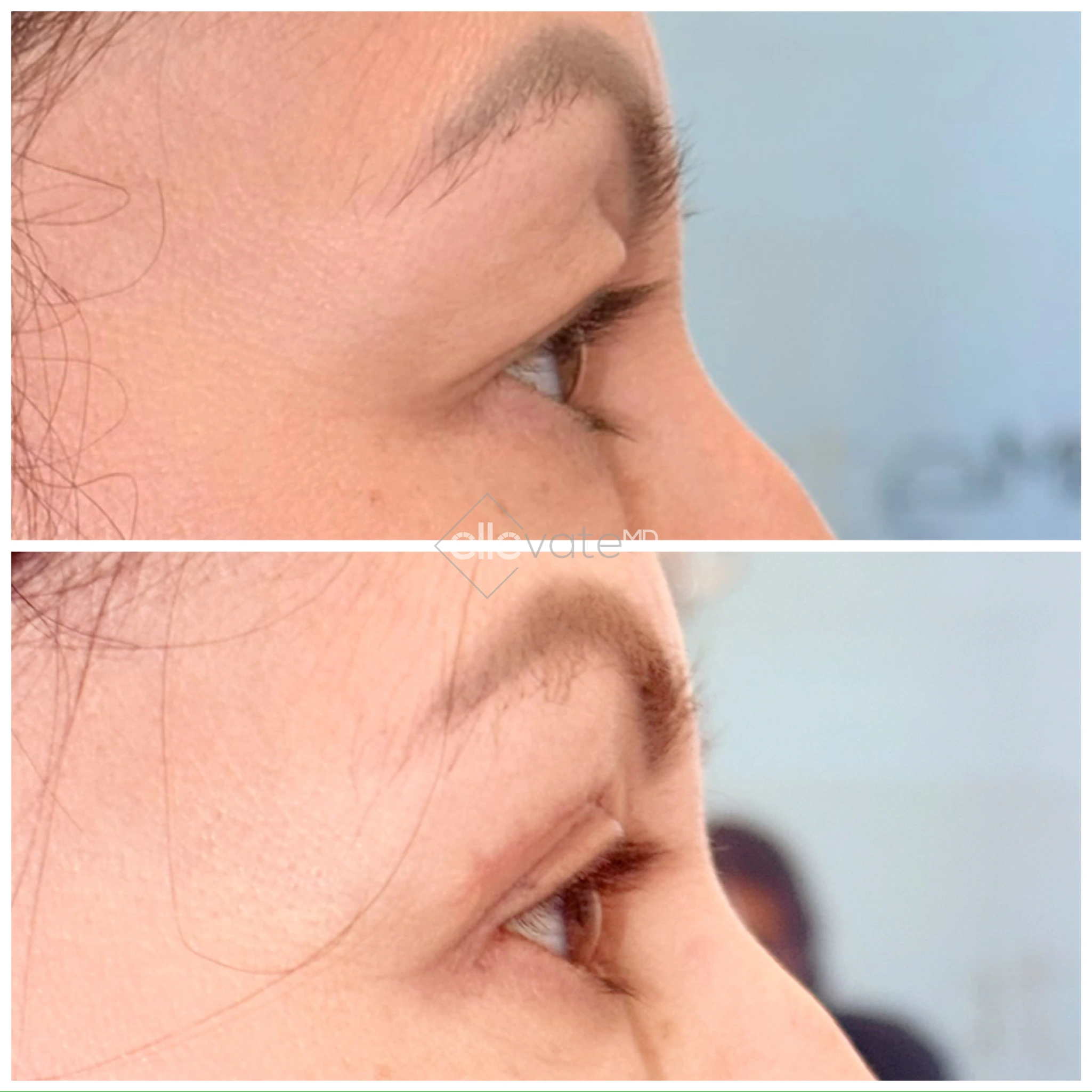 Before and after profile view of upper eyelid lift with refined eyelid appearance