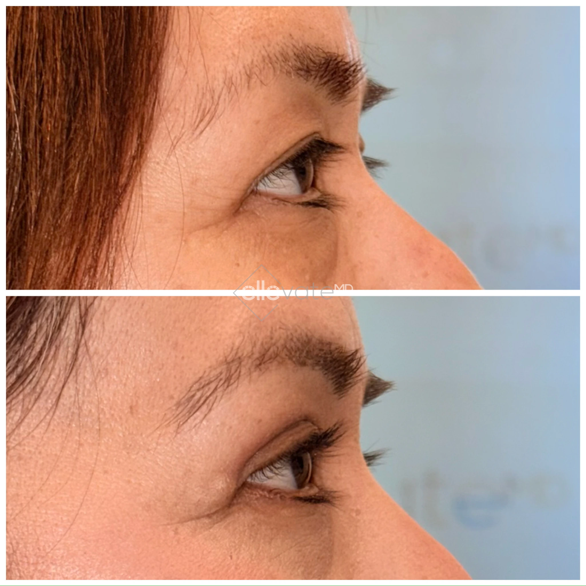 Before and after profile view of upper eyelid lift showing lifted eyelid contour