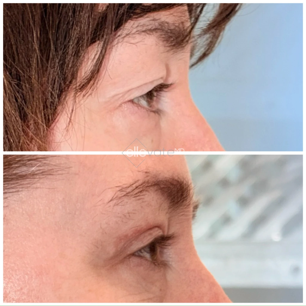 Before and after profile view of upper eyelid lift showing improved eyelid elevation
