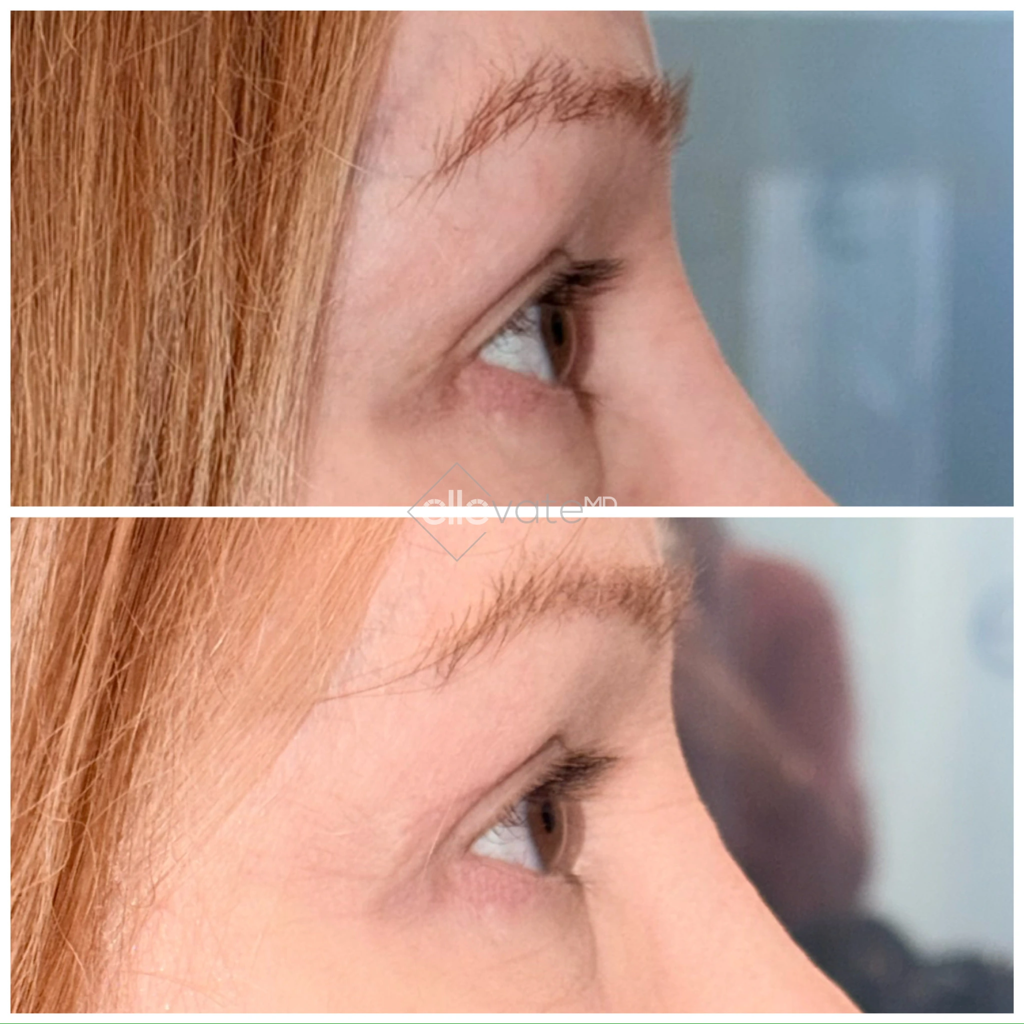 Before and after profile view of upper eyelid lift showing refined eyelid position