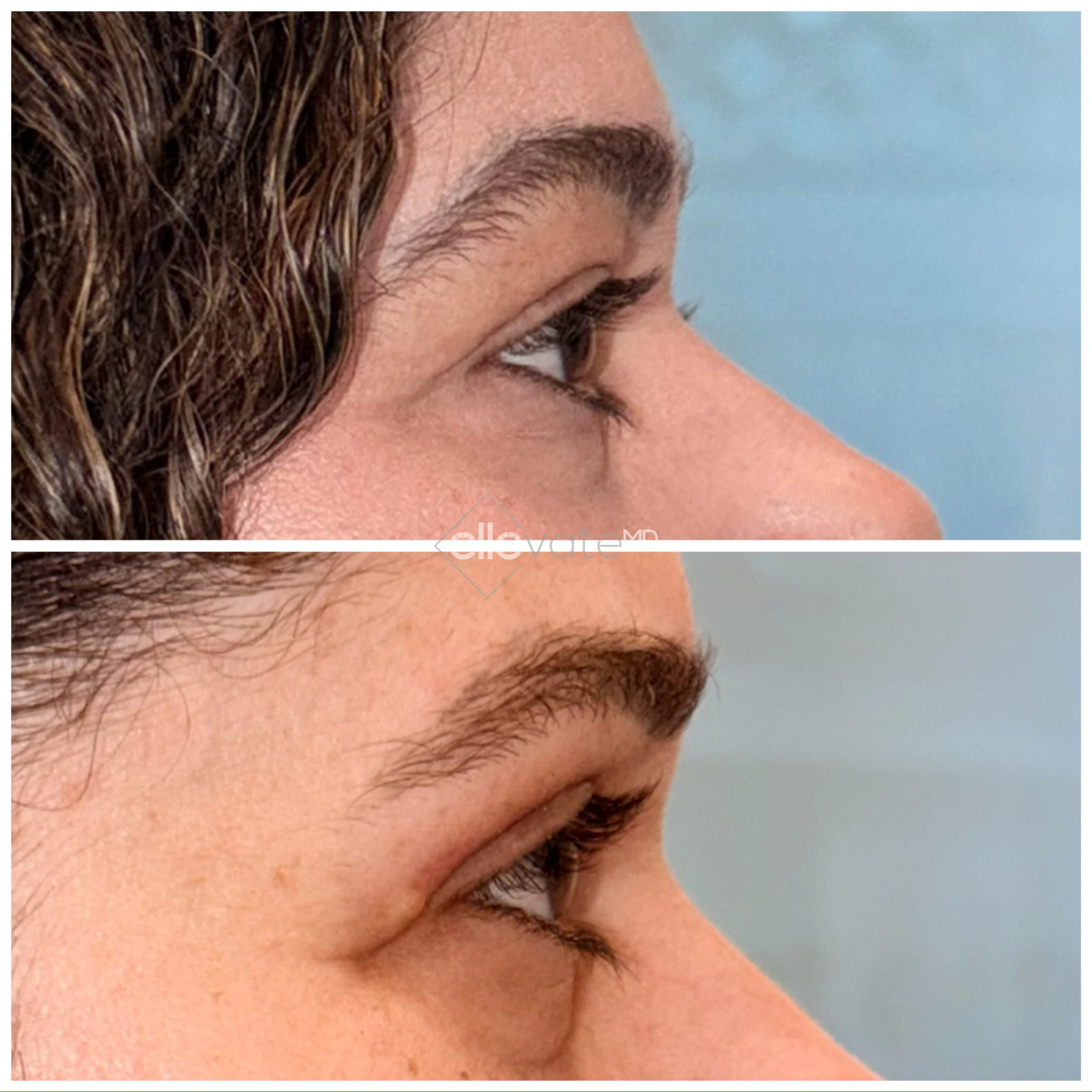 Before and after profile view of upper eyelid lift showing lifted eyelid appearance