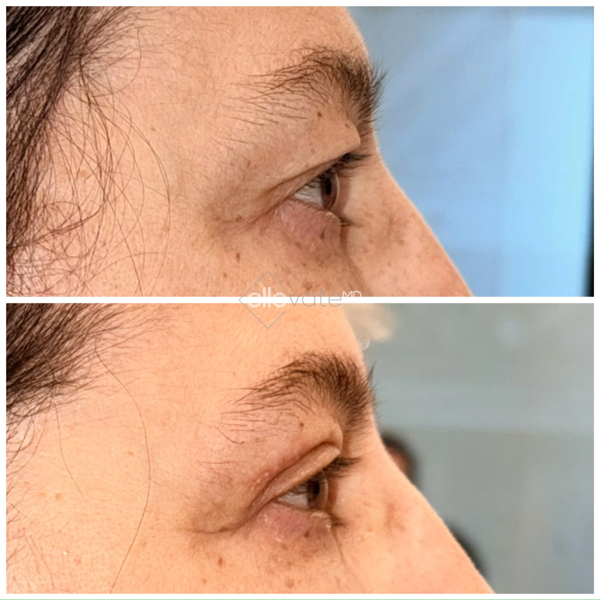 Before and after profile view of upper eyelid lift showing improved eyelid contour